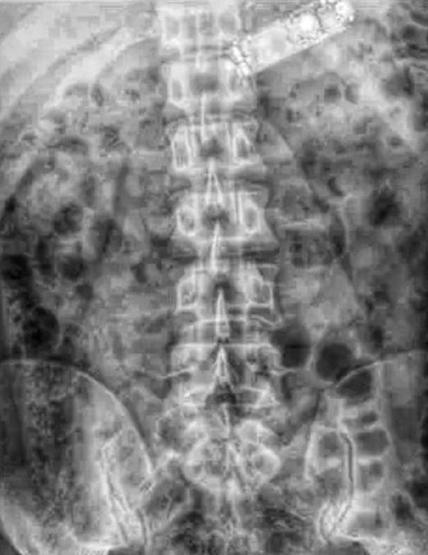 Prisoner flees Málaga hospital after claiming to have swallowed mobile phone